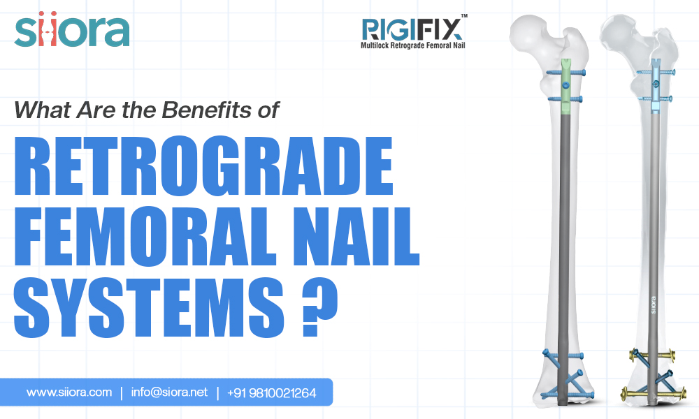 What Are the Benefits of Retrograde Femoral Nail&nbsp;Systems?